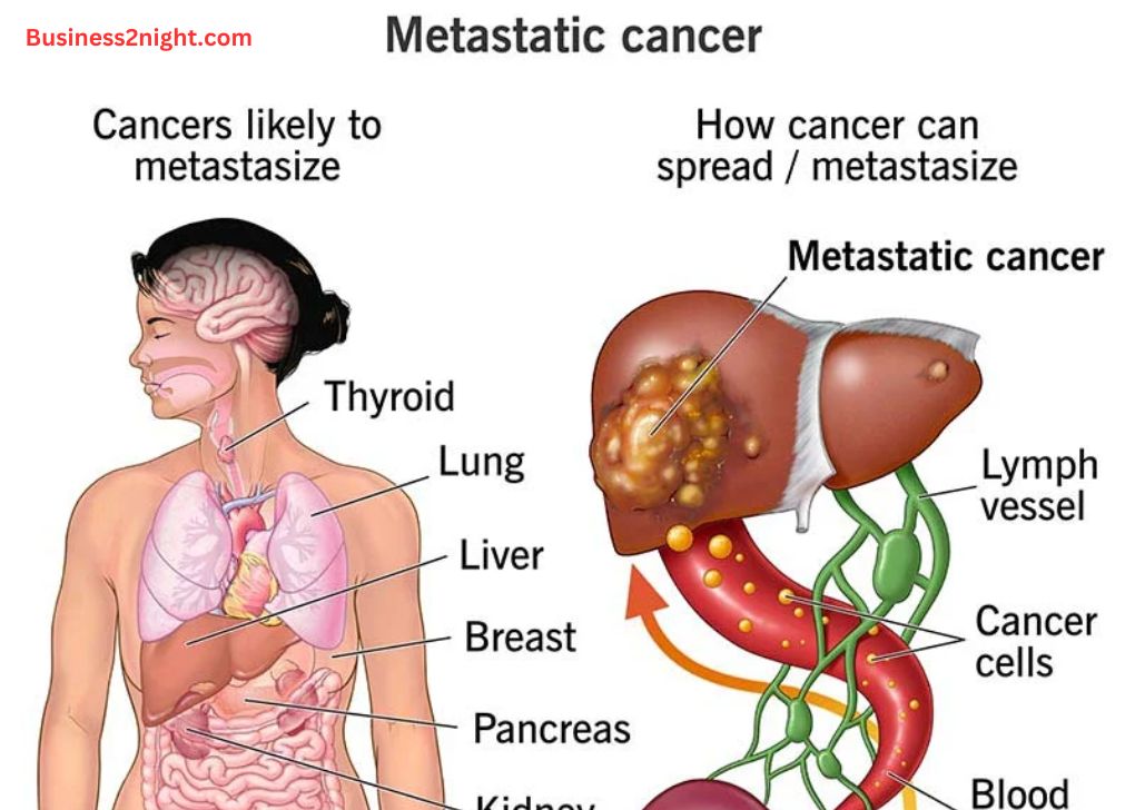 The Metastatic Process: What You Should Know